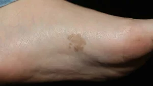 Brown spots on the bottom of feet